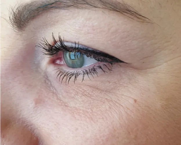 Before and after Botox frown line treatment at AlyneMD — before photo