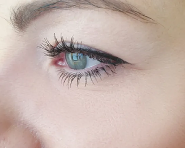 Before and after Botox frown line treatment at AlyneMD — after photo