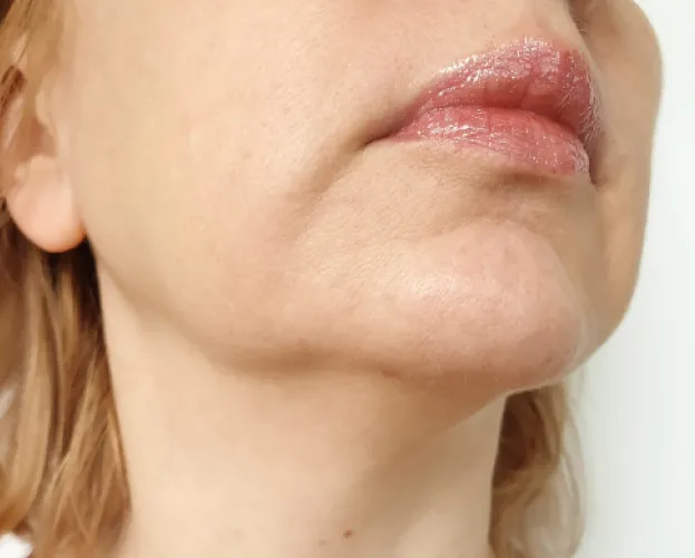 Dermal filler treatment at AlyneMD