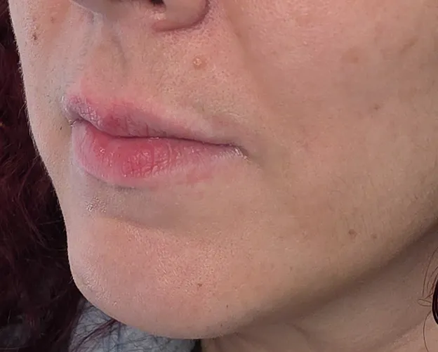 Before dermal filler treatment; individual results vary