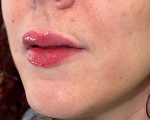 After dermal filler treatment; individual results vary