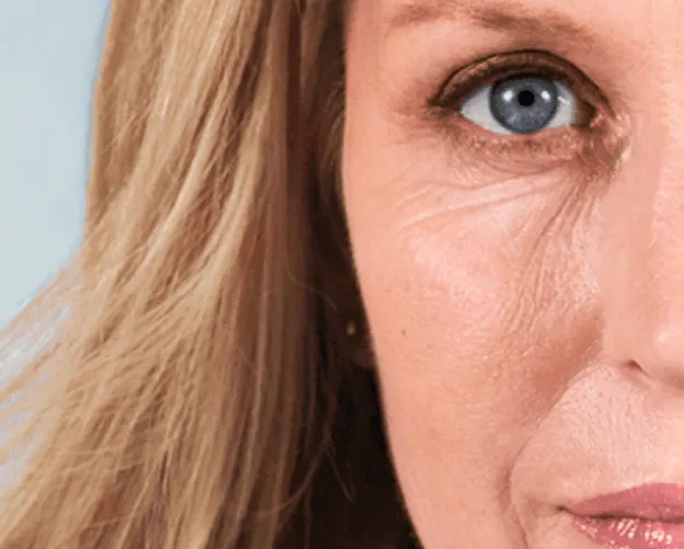 Before Botox treatment; individual results vary