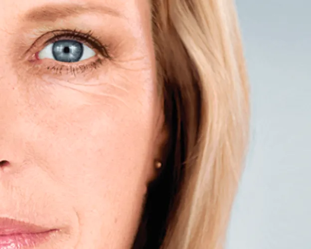 Woman with fine lines around the eyes — Botox treatment area
