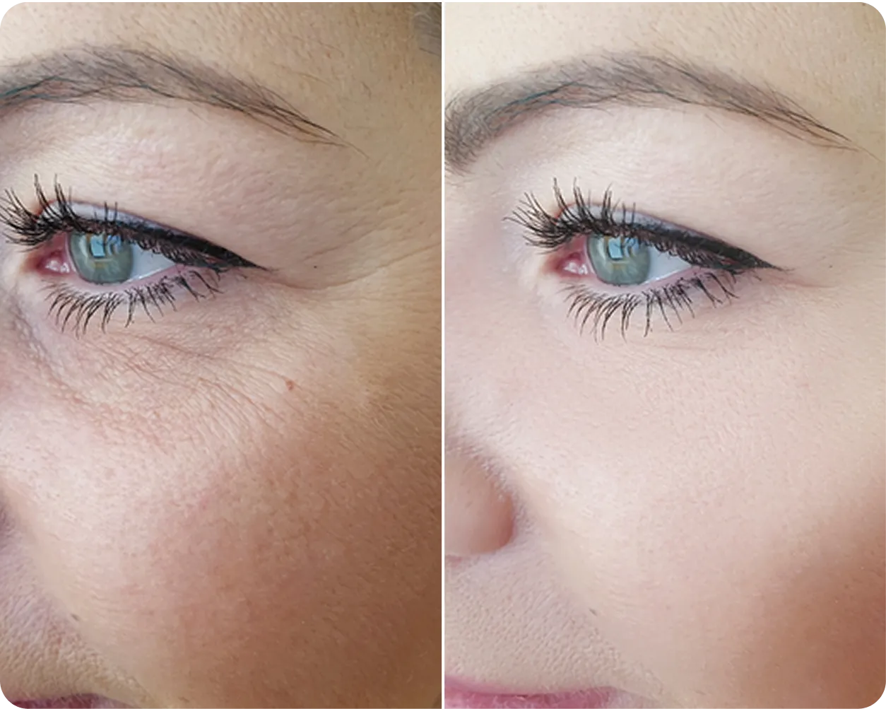 Before and after Botox wrinkle reduction at AlyneMD — natural physician-led results
