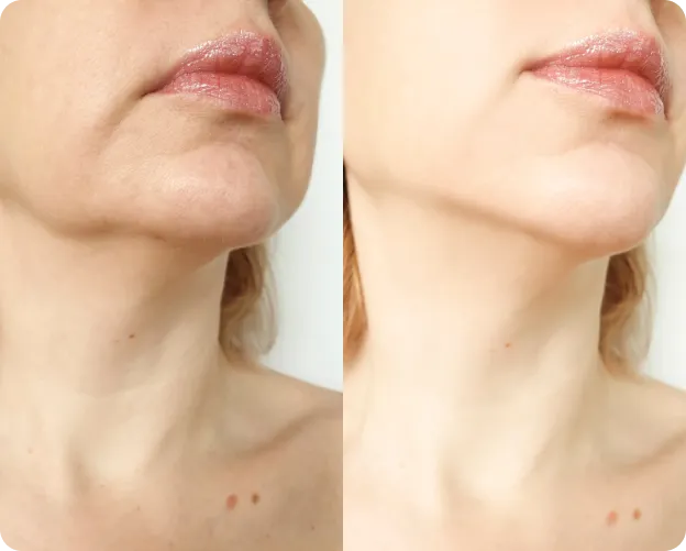 Dermal Fillers - Before and After