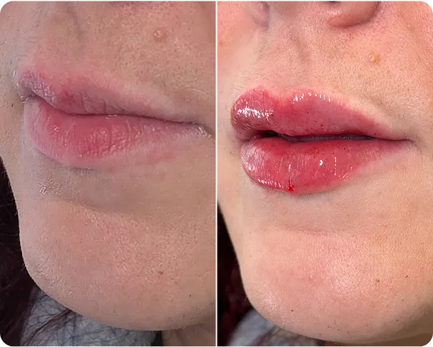 Dermal Fillers - Before and After