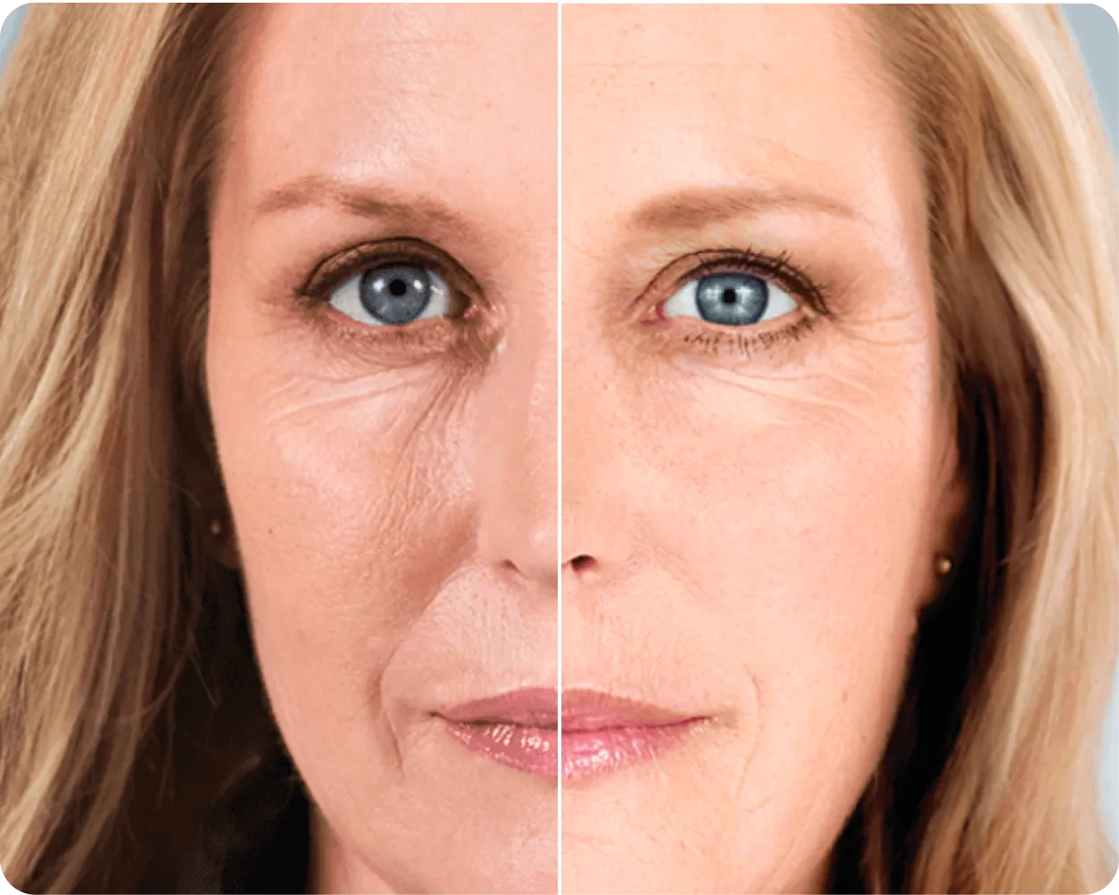 Biostimulators - Before and After