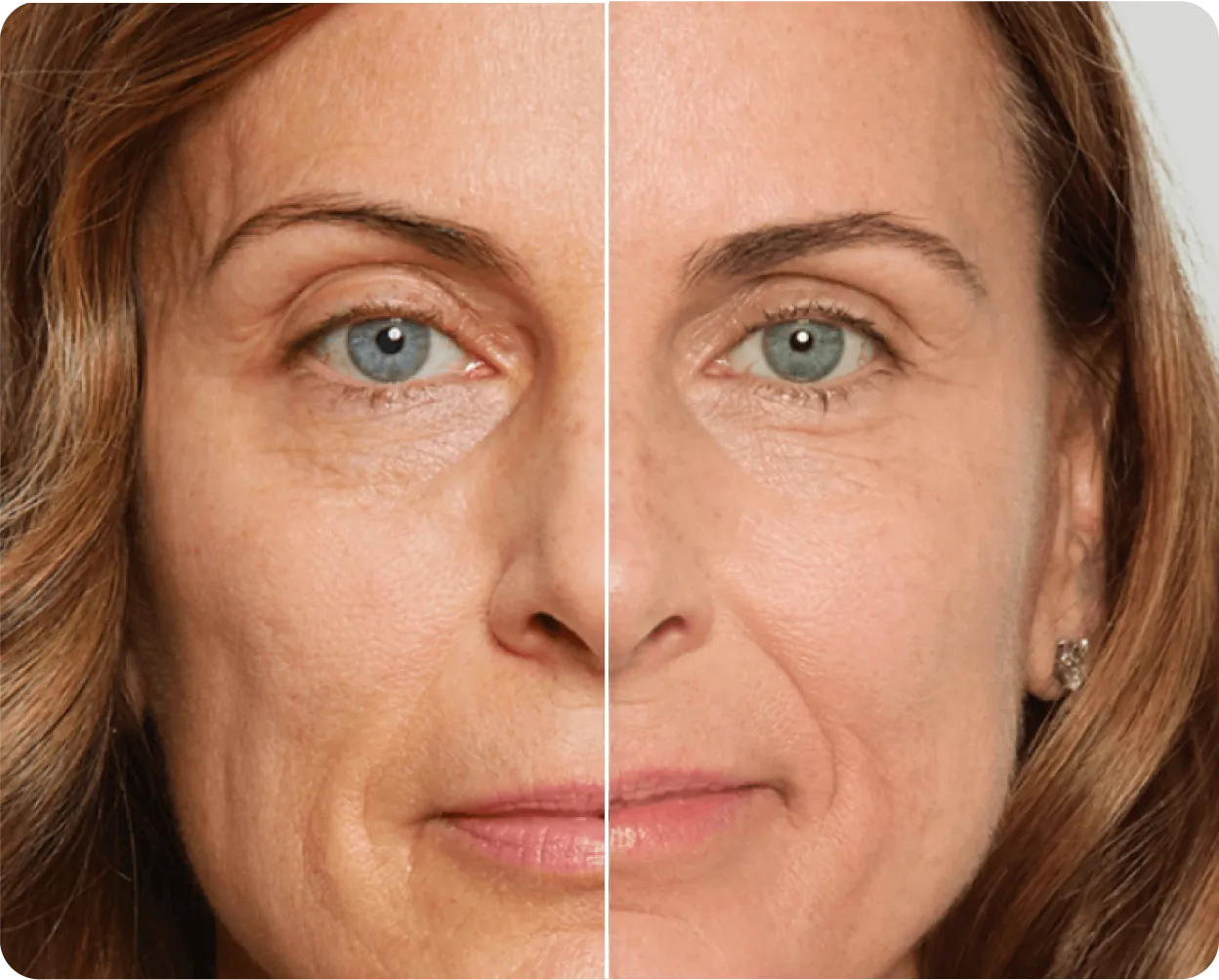 Biostimulators - Before and After