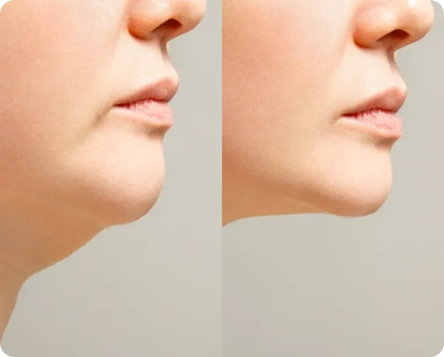 MyEllevate Neck Lift - Before and After