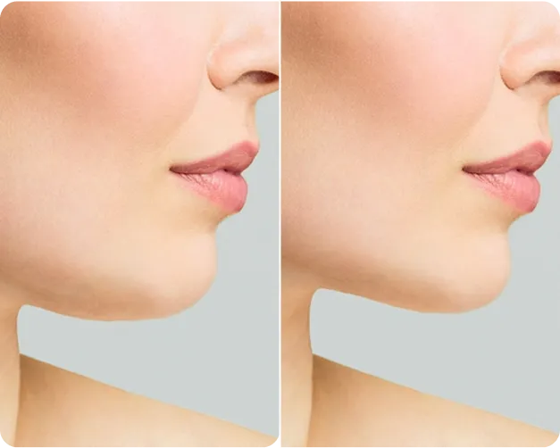 MyEllevate Neck Lift - Before and After