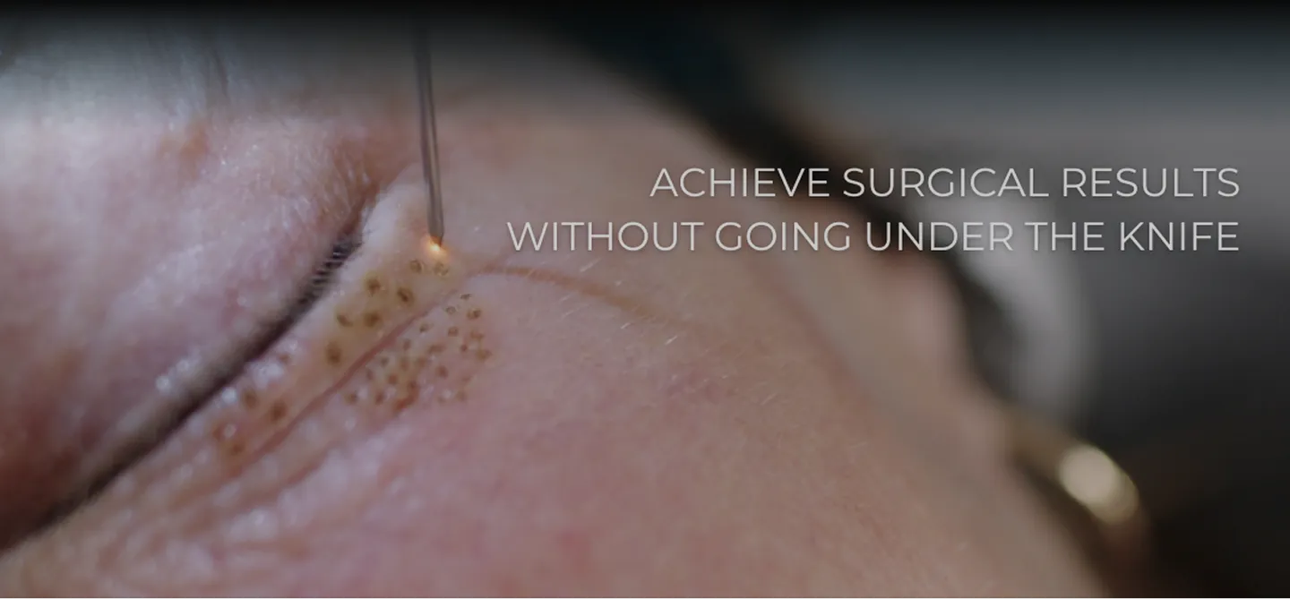 Plexr plasma pen treatment at AlyneMD