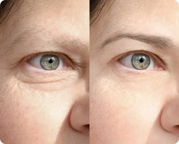 Plexr Plasma Skin Tightening Before and After Images