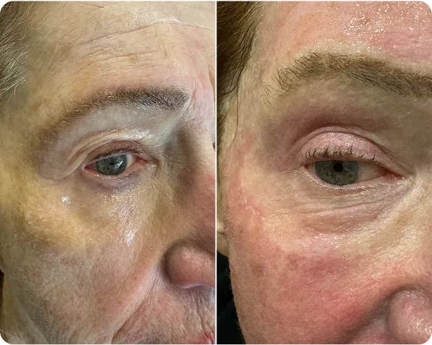 Plexr Plasma Skin Tightening Before and After Images