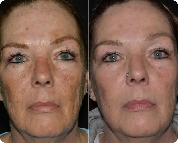 Ultra 1927 Before and After