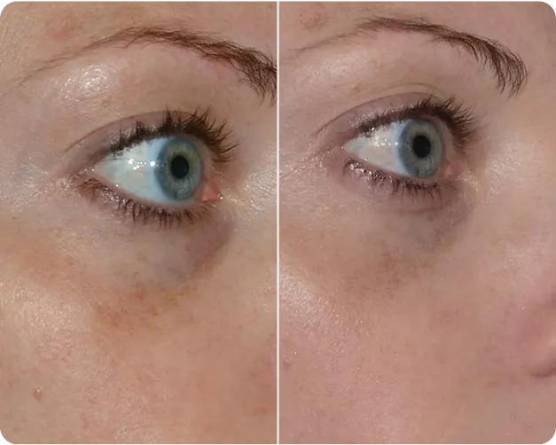 Ultra 1927 Before and After