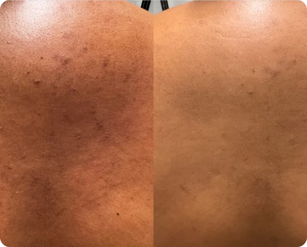 Dual MultiFrax - Before & After Images