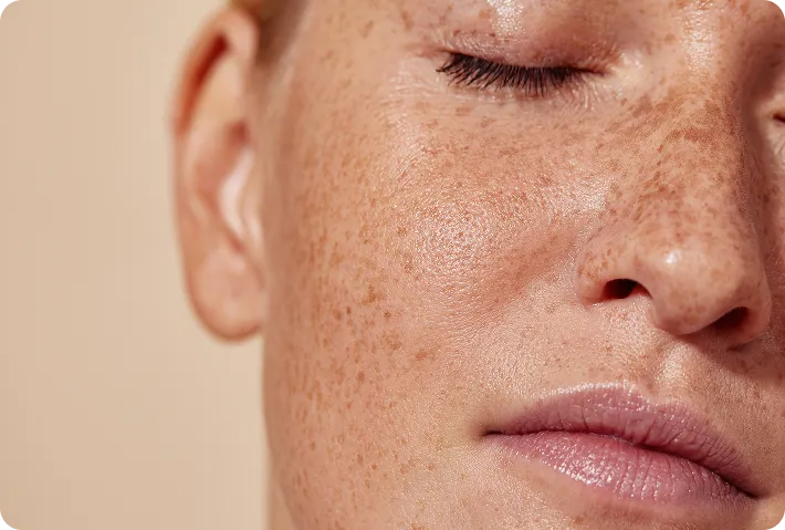 Pico Laser Treatment
