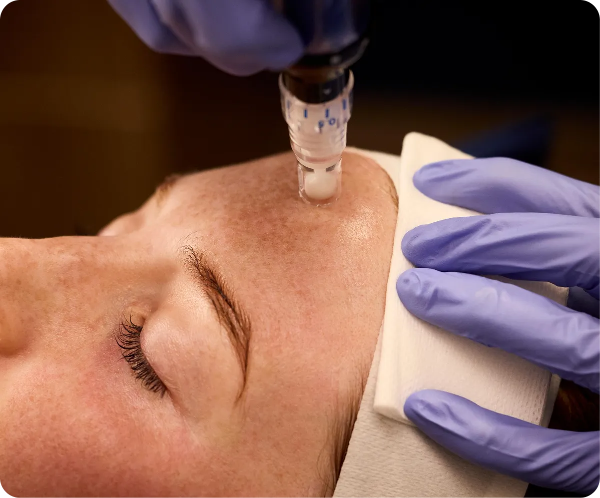Microneedling Treatment