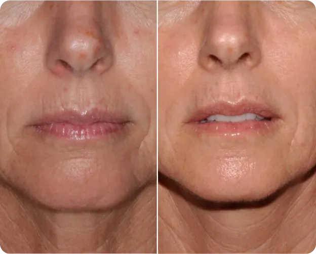 Genius RF Microneedling Before and After