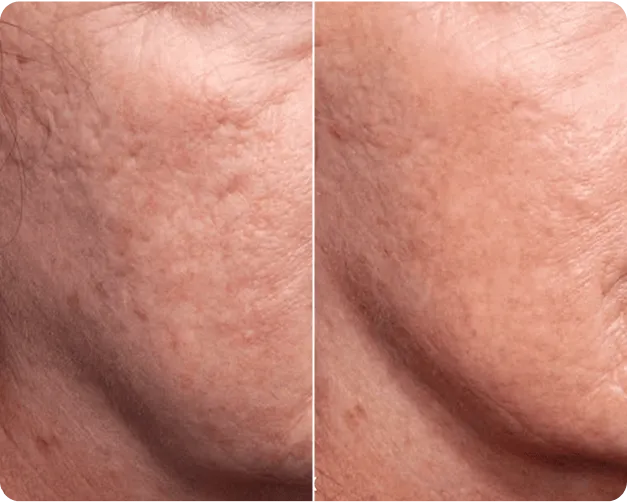 Genius RF Microneedling Before and After