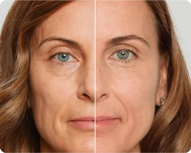 Sculptra/radiesse - Before and after 