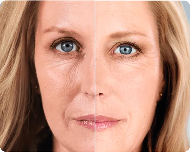 Sculptra/radiesse - Before and after 