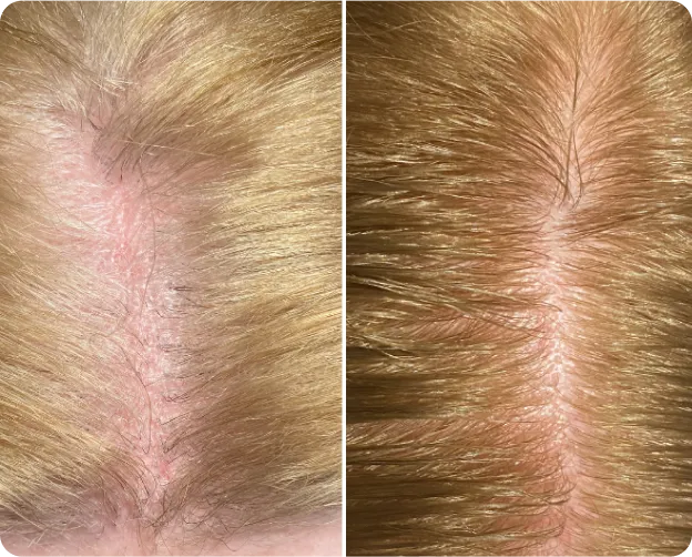 Keralase - Before and after Image