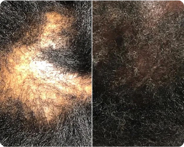 Keralase - Before and after Image
