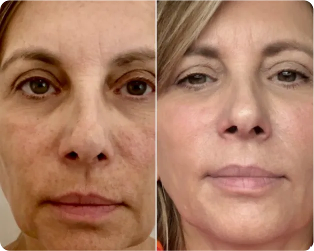 Fotona - before and after