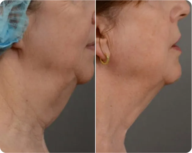 Fotona  - before and after 