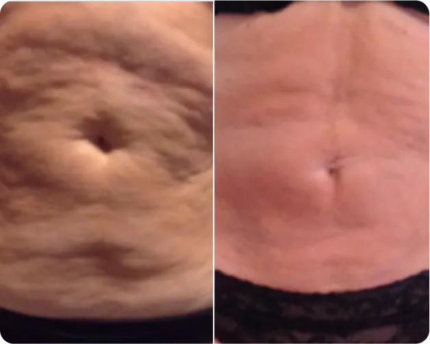 Fotona  - before and after 