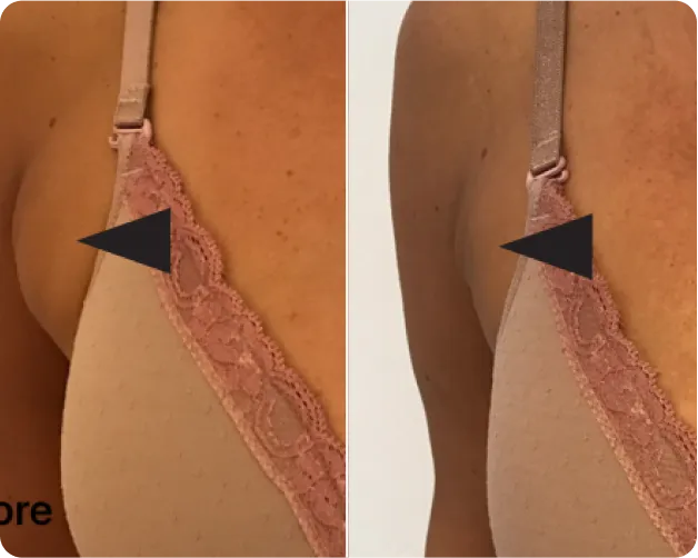 Fotona  - before and after 