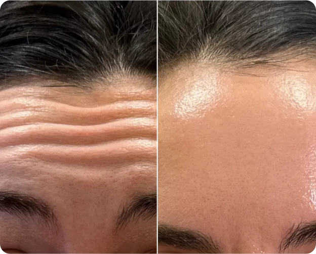 Before and after Botox treatment at AlyneMD — patient results by Dr. Sandhu