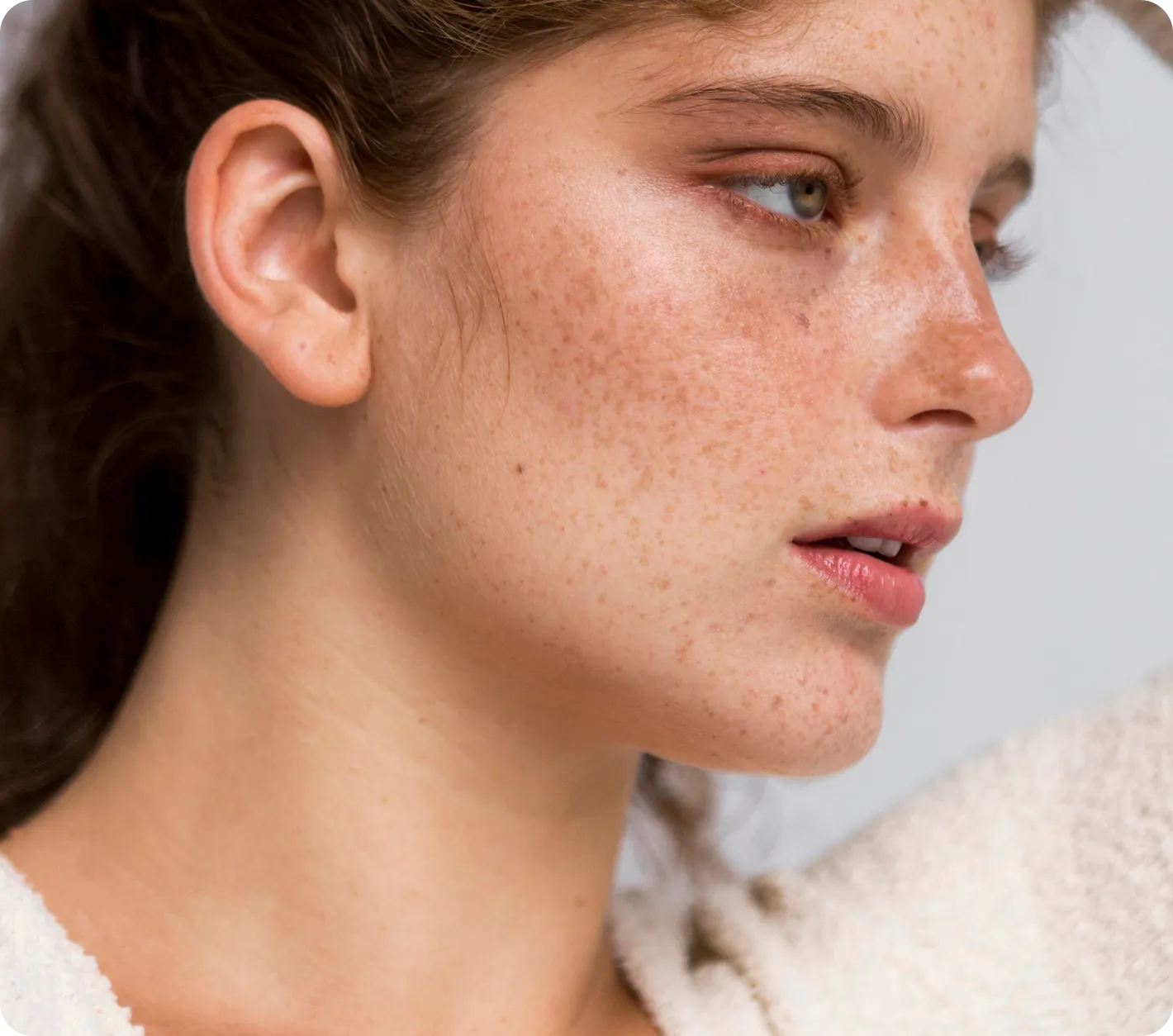 Acne Scar Solutions