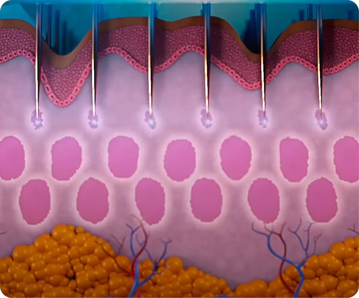 Genius RF Microneedling