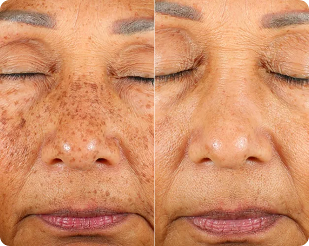 Pico Laser - Before and After