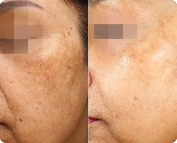 Pico Laser - Before and After