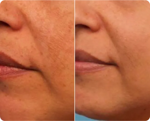 Q-Switched Laser Treatment - Before and After