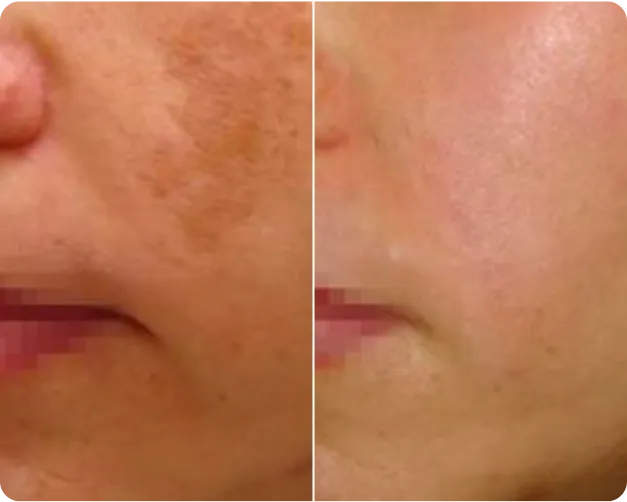 Q-Switched Laser Treatment - Before and After