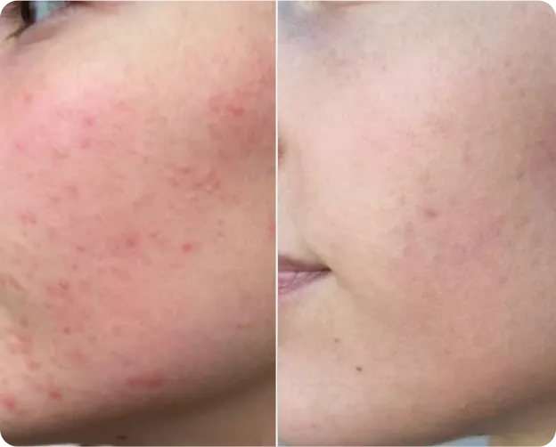 SkinPen  treatment - Before and after