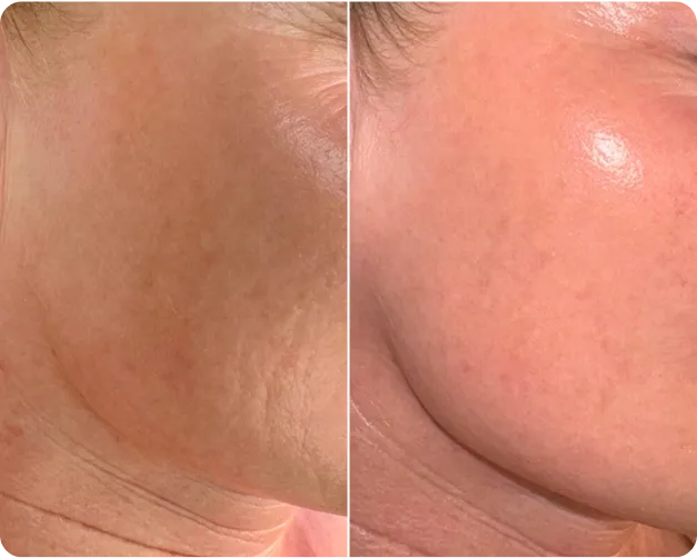 SkinPen  treatment - Before and after