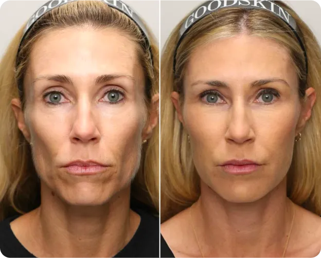 Renuva® Facial Volume - before and after