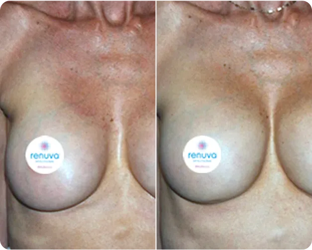 Renuva before and after