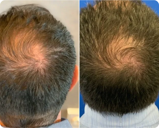 PRP Treatment - Before and After 