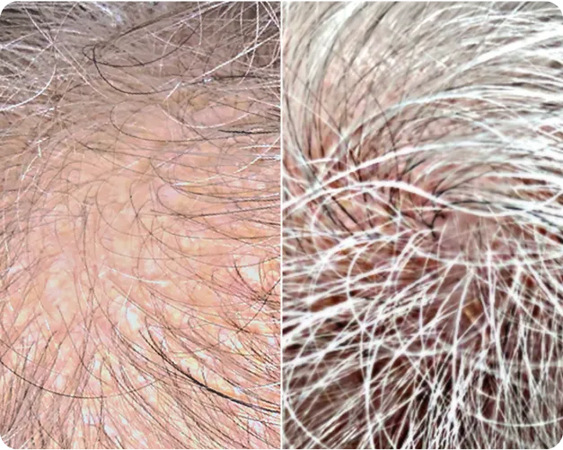 PRP Treatment - Before and After 