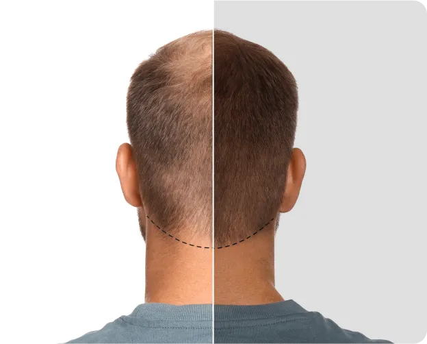 FUE Hair Transplant - before and after 