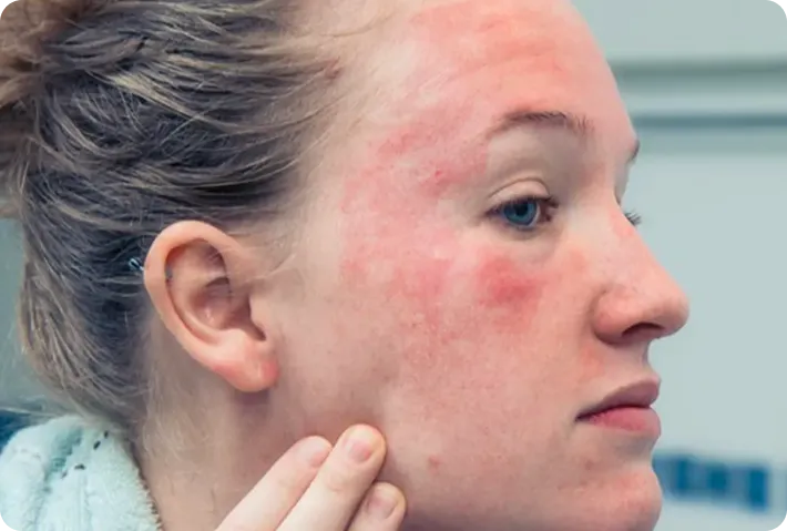 Doctor-Led Rosacea & Facial Redness