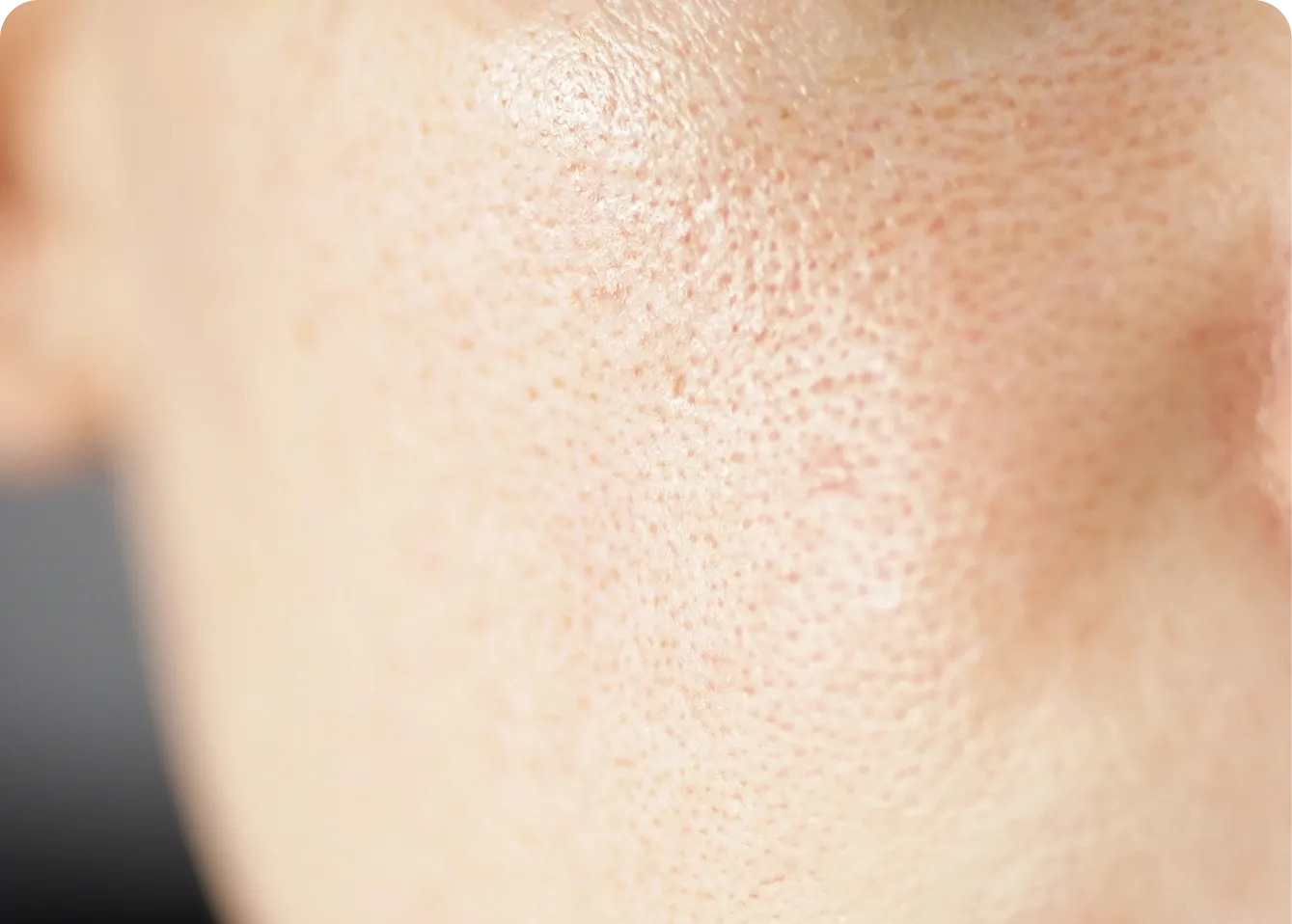 Pores Treatment