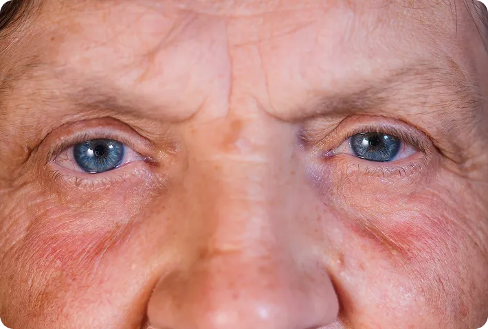 Non-Surgical Eye & Eyelid Treatments