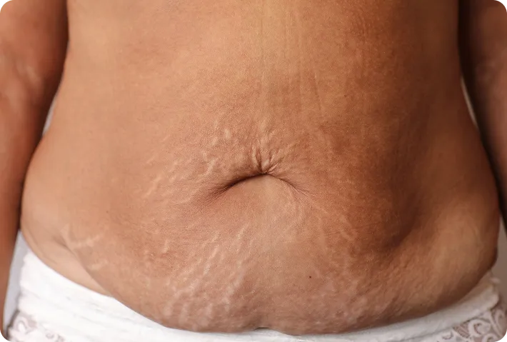 Body Skin Quality & Stretch Marks